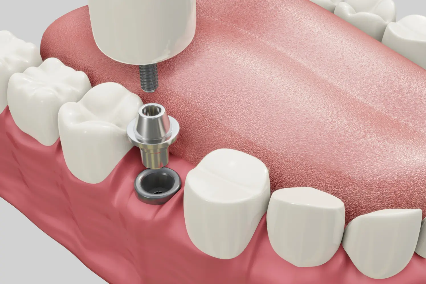 Implantaat implantaten zetten